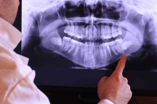 Best Emergency Wisdom Tooth Extraction in Bernardsville, NJ
